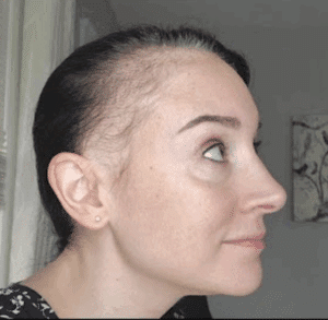 frontal fibrosing alopecia; receding hairline women; receding hairline in women